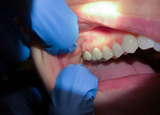 Best Emergency Dentist for Knocked-Out Tooth in Lompoc, CA